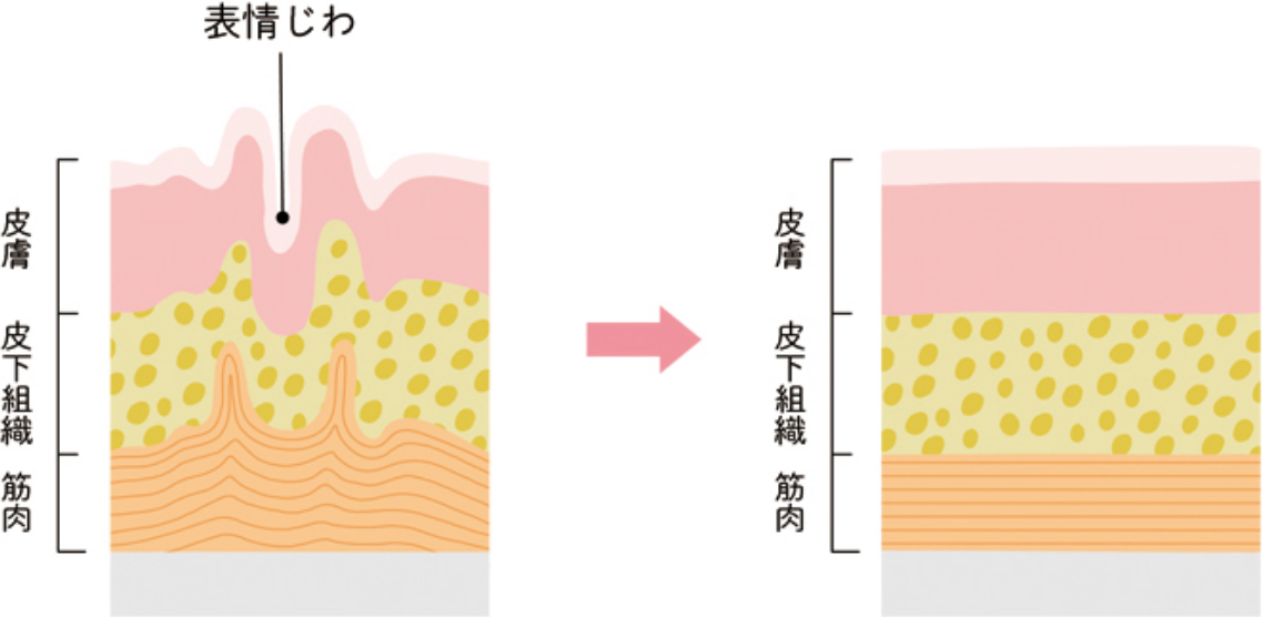 ボトックスビスタ®の効果の図